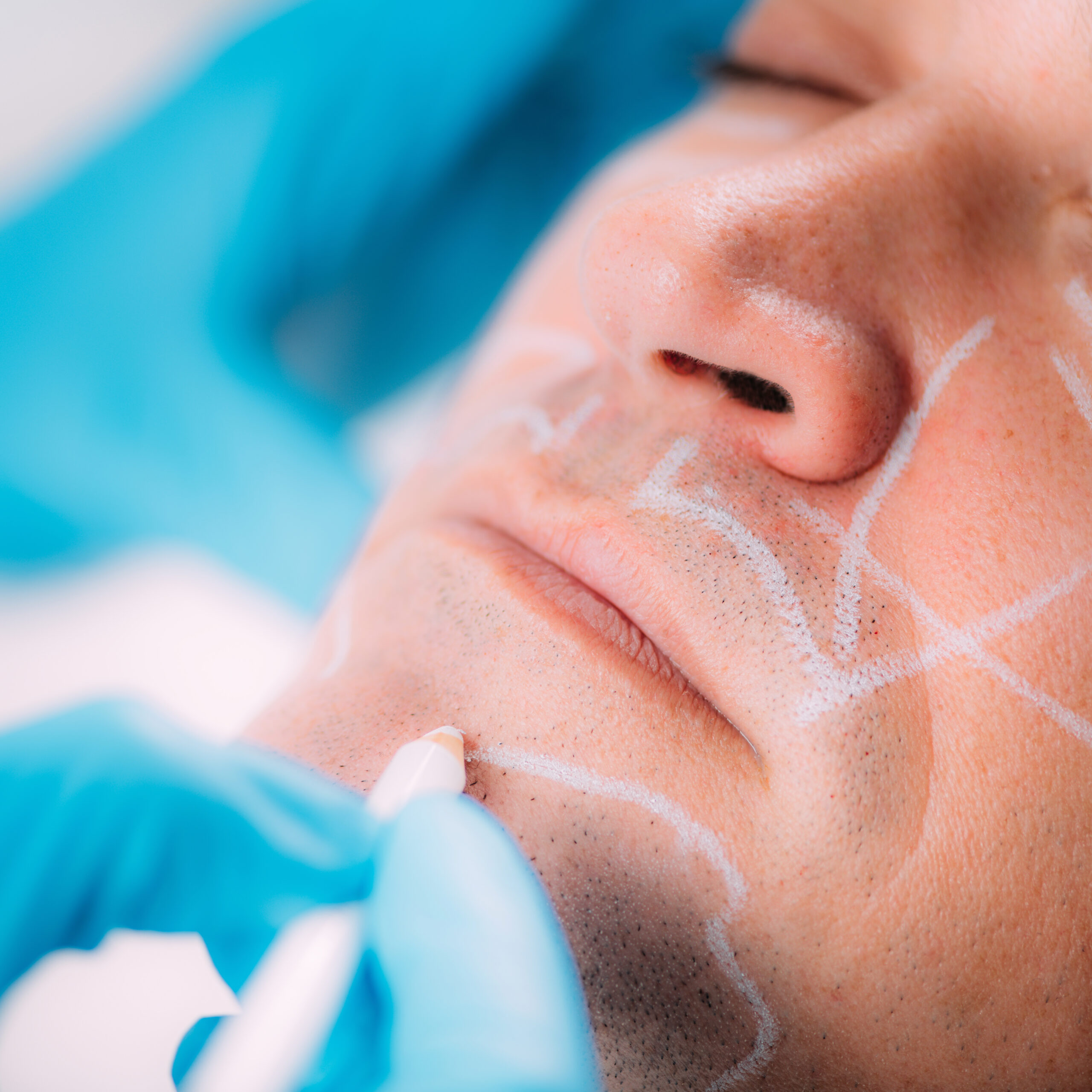 Harmonização Facial